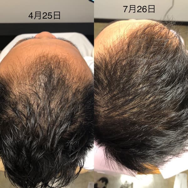 超 発毛メソッド For menの比較画像